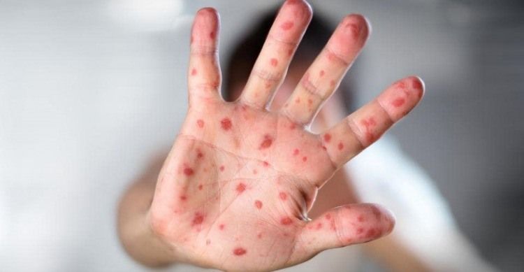 WHO Berikan Tindakan Cegah Penyebaran Virus Cacar Monyet